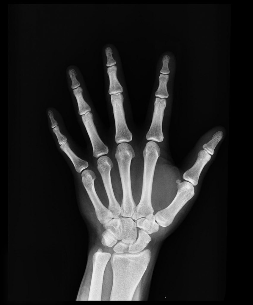 black and white bones hand x ray